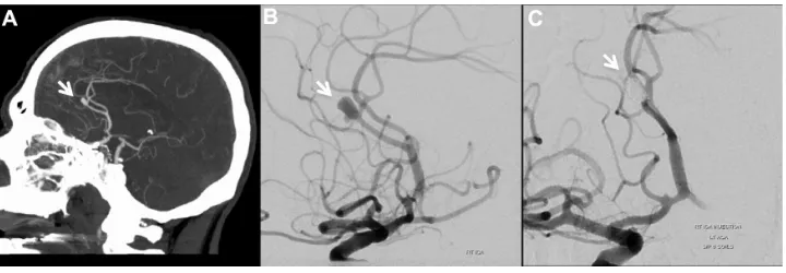 Figure 2 (A) sagittal Ct head angiography demonstrates a2 aneurysm (arrow). Diagnostic subtraction angiography (B) and (C) exhibit complete occlusion of a2 aneurysm after primary coiling (arrows).Abbreviation: Ct, computed tomography.