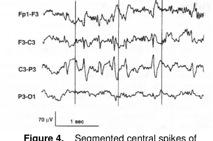Figure 4.    Segmented central spikes of