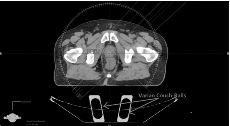 Figure 1: A transversal view of RapidArc plan setup for prostate cancer using single arc technique.