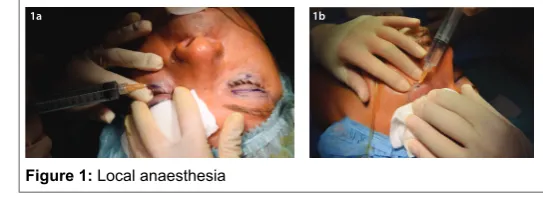 Figure 1: Local anaesthesia