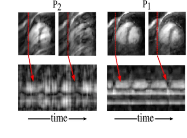 Figure 5 presents compressed sensing of dynamic MRI—real-time acquisition of heart motion—by Michael Lustig and coworkers at the Stanford MRI lab [112, 111].