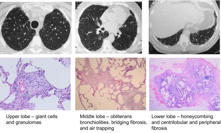 Figure 1 Chronic HSP caused by feather pillows.Notes: Male, 67 years of age, nonsmoker, asymptomatic, but with progressive iLD; on HRCT since 2009