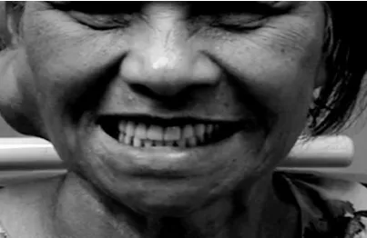 Figure 2: A simulated patient trained to perform on command from the candidate and in process  demonstrate the buccal branch of facial nerve palsy while testing the facial nerve function