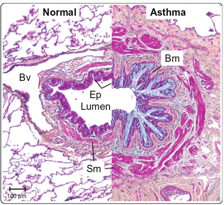 Figure 2 The airways in asthma undergo significant structural remodeling.  Abbreviations:Medium-sized airways from a normal individual and a severe asthmatic patient were sectioned and stained using Movat’s pentachrome stain