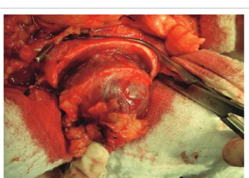 Figure 1: Vascular clamp in place after tumor resection (Original photograph from the first article published by this group of investigators) [17].