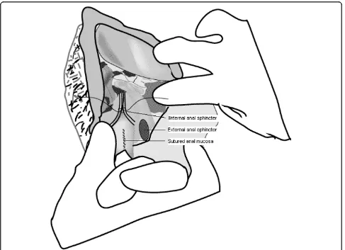 Figure 1 After the first stitch, the internal sphincter muscle may be visualised and appears as a pinkish curtain.