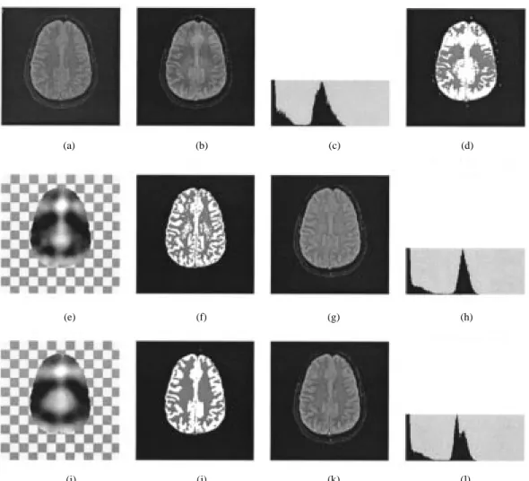 Fig. 9. Comparison of the MEM and the HMRF-EM algorithm on real 2-D MR images with simulated bias field