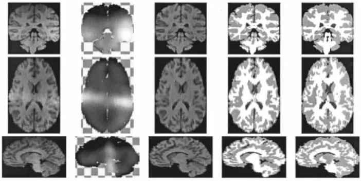 Fig. 11. Data set I from the IBSR. The three rows show the image in coronal, transverse, and sagittal view respectively