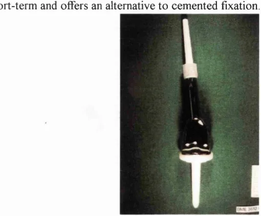 Figure 1-1. Stanmore custom-made tumour prosthesis.