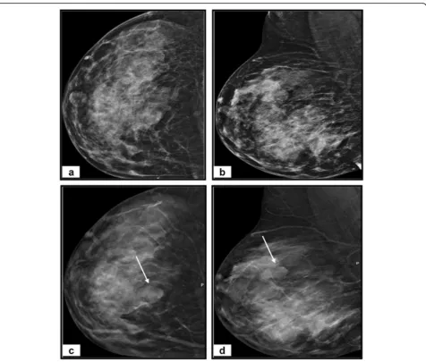 Fig. 5 A 36-year-old woman complains of a right breast lump. a Craniocaudal and (b) mediolateral oblique DM images of left breast revealheterogeneous dense breast (BI-RADS C)