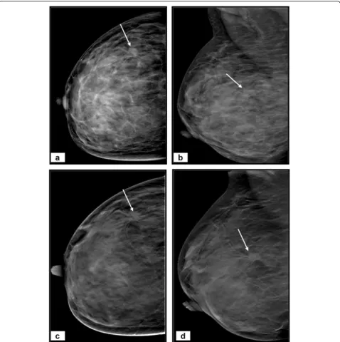 Fig. 3 A 35-year-old woman complains of a right breast lump. a Craniocaudal and (b) mediolateral oblique DM images of right breast revealextremely dense breast (BI-RADS D) with an outer central area of architectural distortion (arrows)