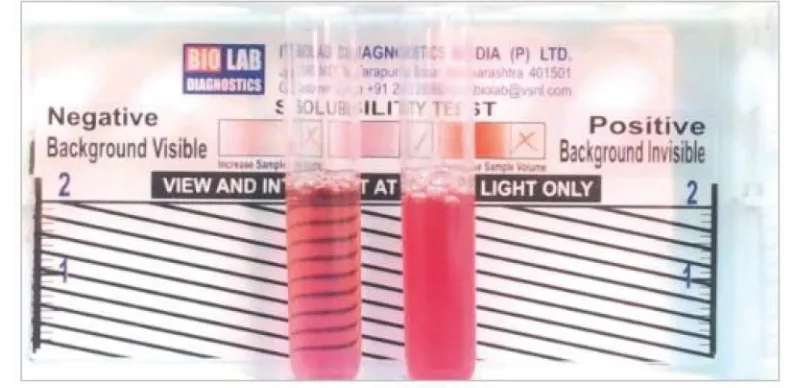 Figure 1 showing the reactivity pattern of the rapid sickle cell hemoglobin-s (dithionate qualitative solubility) test 