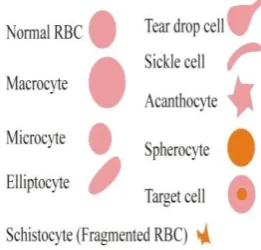 Fig. 1- normal and abnormal rbc’s (https://bigpictureeducation.com/blood-cells-images)   