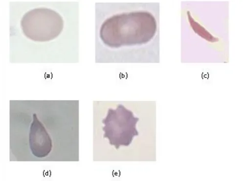 Fig 2- example of acquired mages on blood smear image (a) normal cell; (b) sickle cell; (c) elliptocyte cell; (d) teardrop cell; (e) achantocyte
