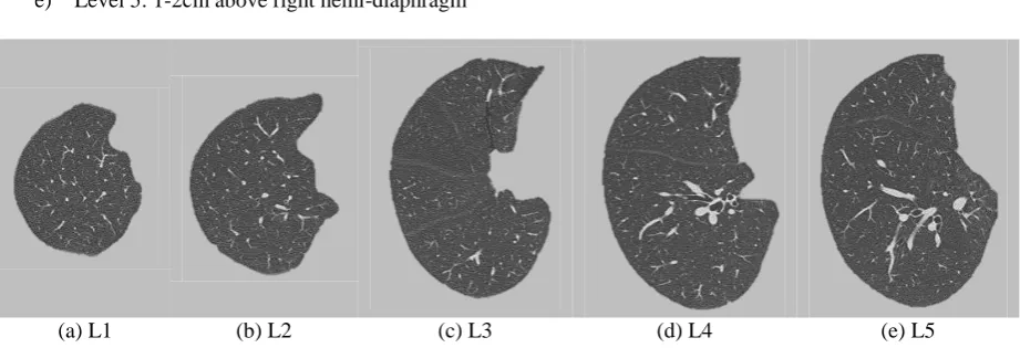 Fig. 1 – Five levels of the Segmented Right Lung. 