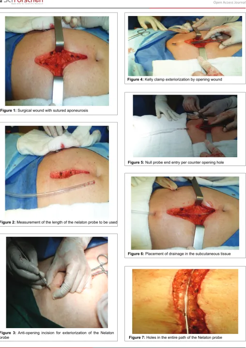 Figure 4: Kelly clamp exteriorization by opening wound