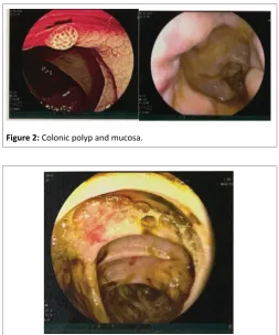 Figure 2: Colonic polyp and mucosa.