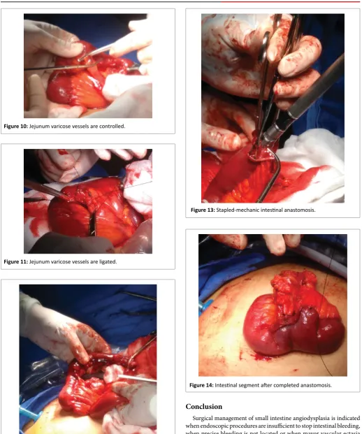 Figure 14: Intestinal segment after completed anastomosis.