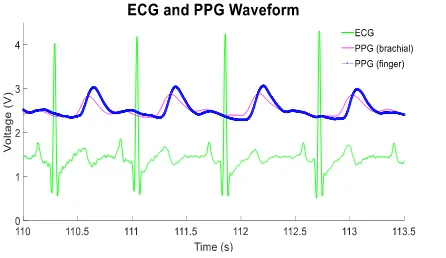 Figure 2 shows the ECG waveform acquired on the chest (green trace) and the PPG waveforms acquired on the brachial artery (pink trace) and middle finger (blue trace)