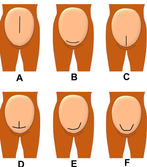 Figure 1.1 :  Type of uterine incision. A: Classical CS, B: Transverse Lower Segment CS, C: Vertical lower segment CS, D: Inverted-T incision, E: J-Shape incision and F: U-shape incision
