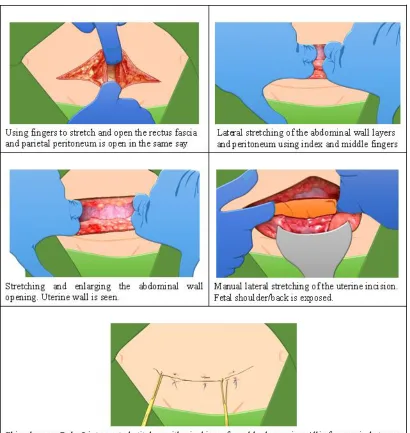 Figure 1.2: Main differences in Misgav-Ladach Technique of Caesarean Section compared to conventional methods