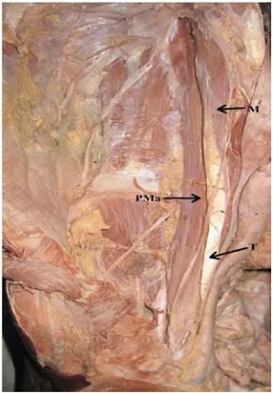 Figure 2: Bilateral psoas minor muscle (T-Tendon of Psoas minor; M-muscle belly of Psoas minor