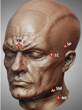 Figure 1: Showing topographic position of sample collected. SP: Scalp, FH: Forehead, LC: Lateral canthus, SM: Submandibular area, NK: Neck (Adapted from CGSociety.org)  