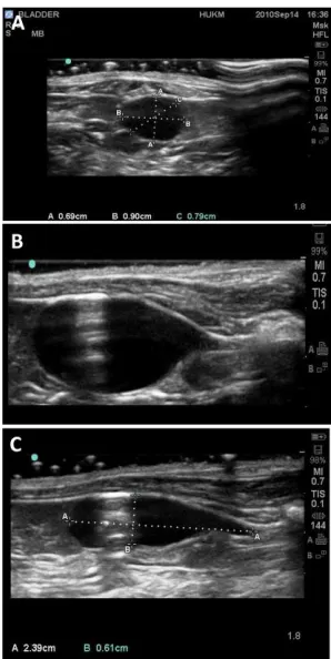Figure 4: Urodynamic study representative diagram, of urinary bladder  urodynamic evaluation (cystometry), vertical (pressure), horizontal (volume), showing urinary 