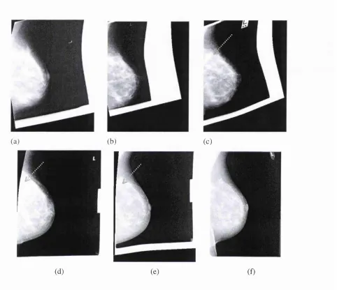 Figure 2: The same series of temporal mammograms (as in Figure 1) registered to the 