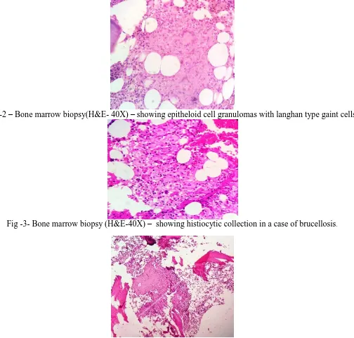 Fig -3- Bone marrow biopsy (H&E-40X) –  showing histiocytic collection in a case of brucellosis 