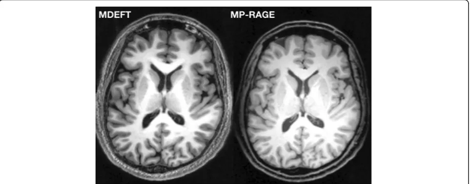 Fig. 1 Two different MR pulse sequences were applied to acquire high-resolution 3D T1-weighted images: MP-RAGE and MDEFT pulse sequence