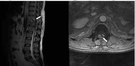 Figure 2: A 25 year old male with history of fall presented with inability to move bilateral lower limbs