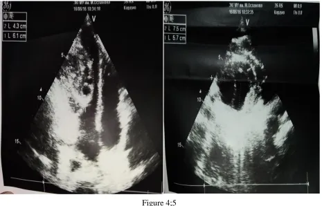 Figure 3 ECG (14.06.16): Sinus rhythm 74 beats per minute, normal EOS position, violation of blood supply to the lower left ventricular wall