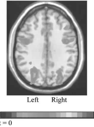 Figure 6. Comparison of laboratory learners showing activation in both left and right middle frontal areas for Chinese, relative to baseline
