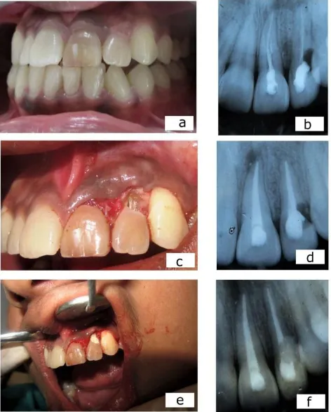 Figure a - clinical photograph showing discoloured tooth #9 and 10 and pinkish discoloration in cervical aspect of tooth # 10