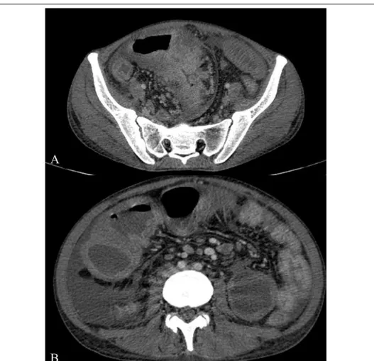 Figure Error! Main Document Only.: Contrast enhanced images show circumferentially enhancing mass in the terminal ileal region with features of proximal obstruction
