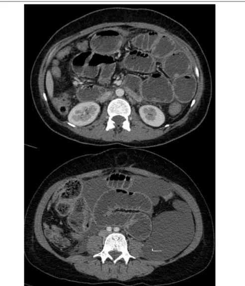 Figure Error! Main Document Only.: Case of Adhesions. Contrast enhanced images shows features of high grade mechanical obstruction with transition at distal ileum