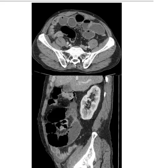 Figure Error! Main Document Only.: Contrast enhanced CT images shows small bowel obstruction with abrupt transition in the distal ileum