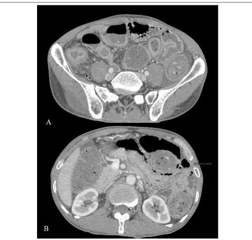 Figure Error! Main Document Only.thickening with pericecal fat stranding. Long segment small bowel thickening with focal strictures also : Crohn’s disease
