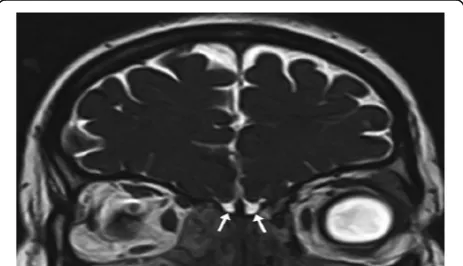 Fig. 1 Coronal T2-WI showing segmentation of the olfactory bulbfor volumetric assessment