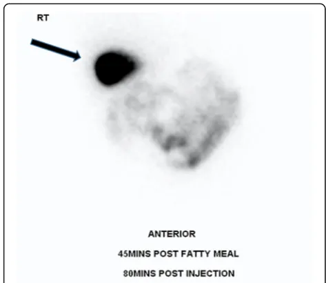 Fig. 5 Axial T2-weighted MRI of the abdomen. There is a largegallstone within the gallbladder which is markedly hypointenserelative to the surrounding hyperintense bile