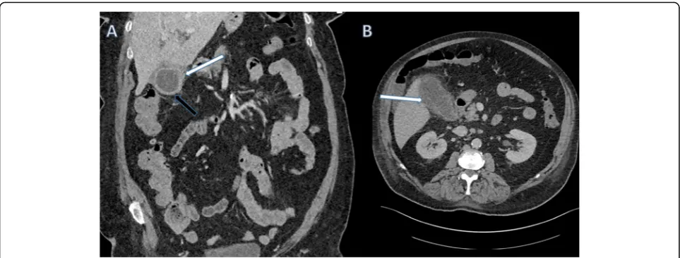 Fig. 11 Coronal contrast-enhanced CT of the abdomendemonstrating a markedly distended gallbladder