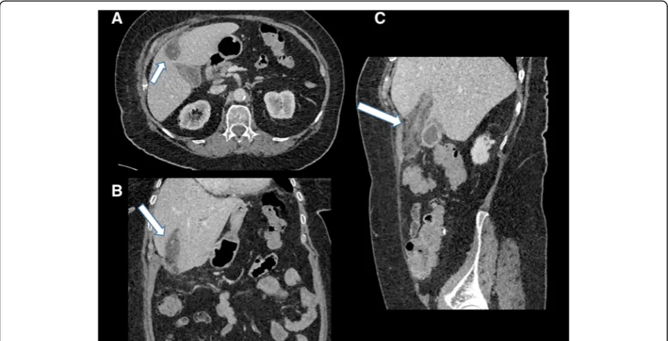 Fig. 15 Axial (a) and sagittal (b) contrast-enhanced CT of the abdomen demonstrating peripheral calcification of the gallbladder wall (arrows)consistent with porcelain gallbladder