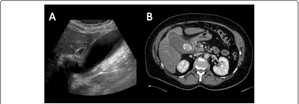 Fig. 16 Sagittal ultrasound of the gallbladder demonstrating a softtissue mass within the gallbladder with internal vascularityconsistent with a gallbladder carcinoma