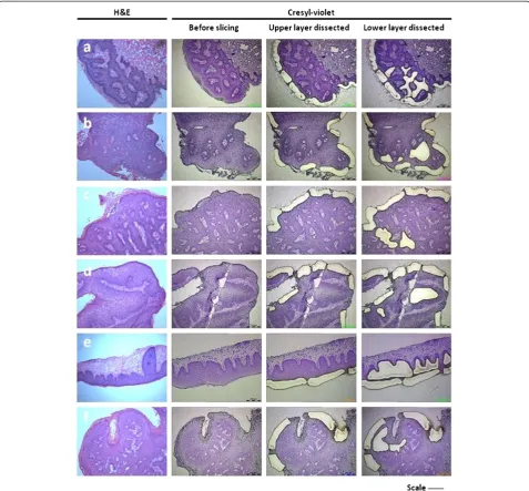 Figure 1 Capture of wart tissue using Laser-Capture Microdissection. The series of photographs identifies the sequential extraction of lowerand upper layers within wart tissue