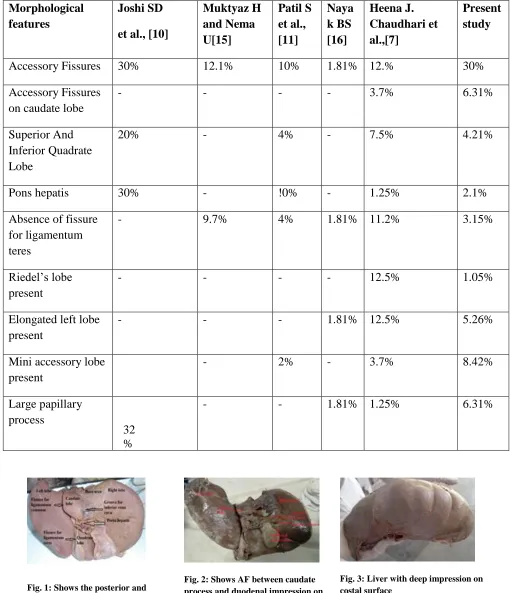 Fig. 2: Shows AF between caudate process and duodenal impression on 