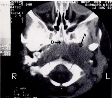 Fig 9.Rhabdomyosarcomaoccurredextensionof temporalbone(A)whichwithnasalobstructionduetonasopharyngeal(B).