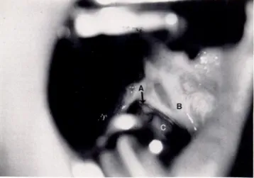 Fig 4.Regionpalateof nasopharyngealstenosis(A) secondaryto distortionandscarringof soft(B)andposteriorpharyngealwall(C)followingtonsillectomyandadenoidectomy.