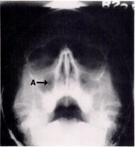 Fig 6.Mucoperiostealthickeninginmaxillarysinuses,a typicalradiographicfindinginallergicrhinosinusitis.Smallair-filledregionof sinus(A)is indicated.