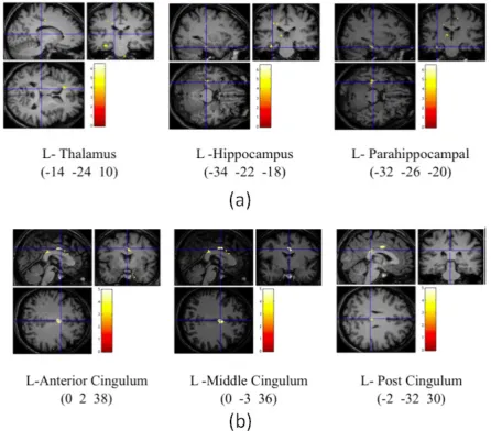 Figure 1. Brain activations in female participants associated with decreased pain threshold (a) and increased pain threshold (b) during laser pain stimulation while being accompanied by a loved one
